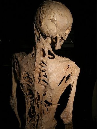 Esqueleto de una persona con fibrodisplasia osificante progresiva (FOP).