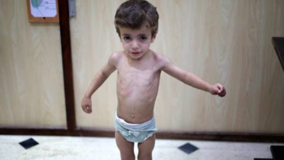 الحصار والجوع يقتل أطفال الغوطة Bbc News عربي