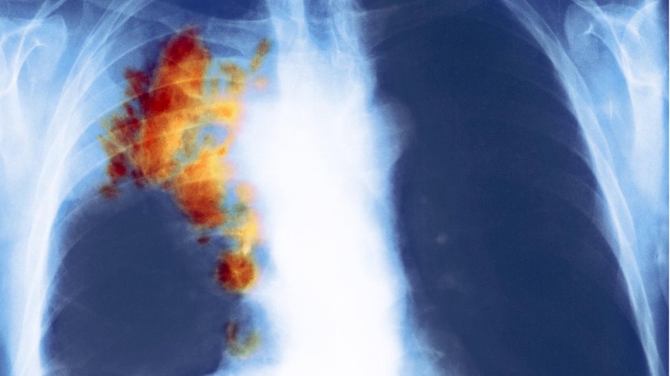 صورة أشعة توضح سرطان في الرئة اليمنى