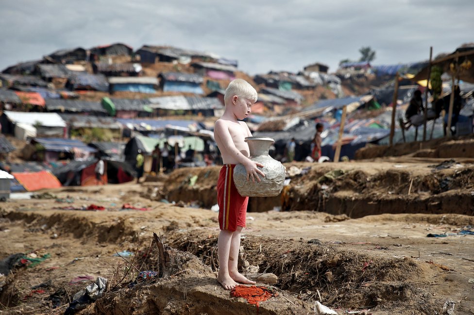 Un niño rohingya albino carga un jarro con agua en un campo de refugiados.