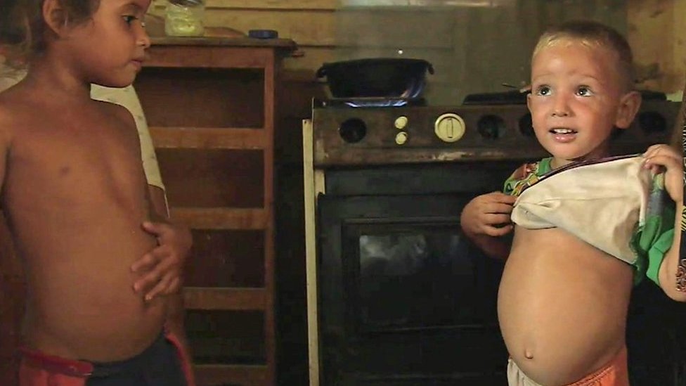 Niño venezolano con la barriga hinchada