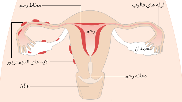 اندومتریوز تمام شکم و لگن پریود می شود Bbc News فارسی