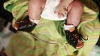 clubfoot disability