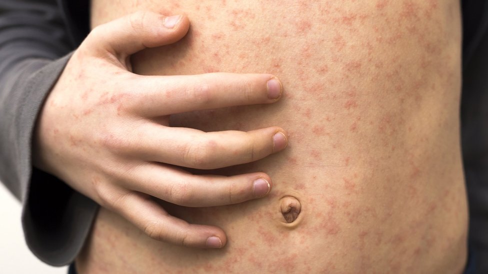 Rise in UK measles cases causing concern