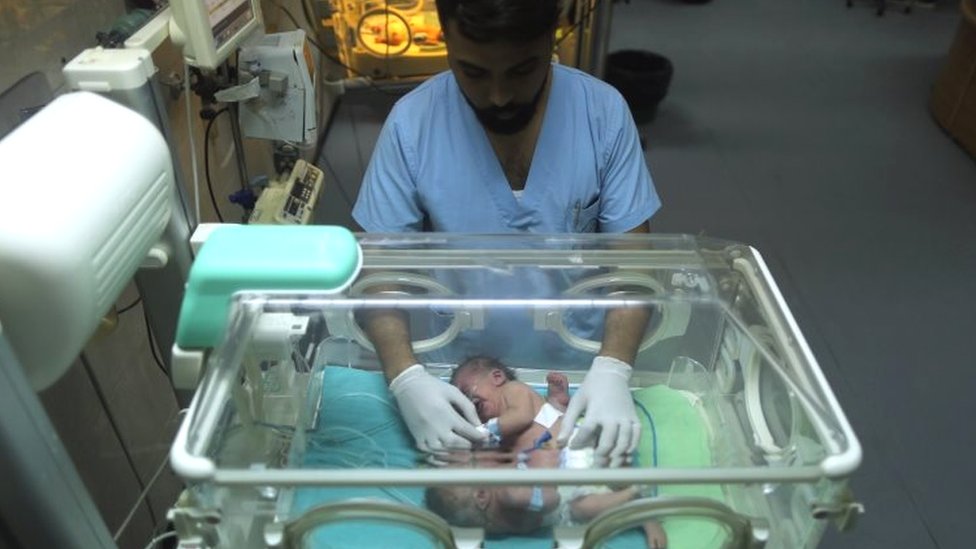 توأم ملتصق في مستشفى الشفاء في غزة
