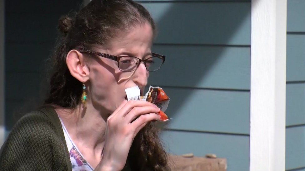 Abby Solomon, estudiante de 21 años que padece síndrome progeroide neonatal