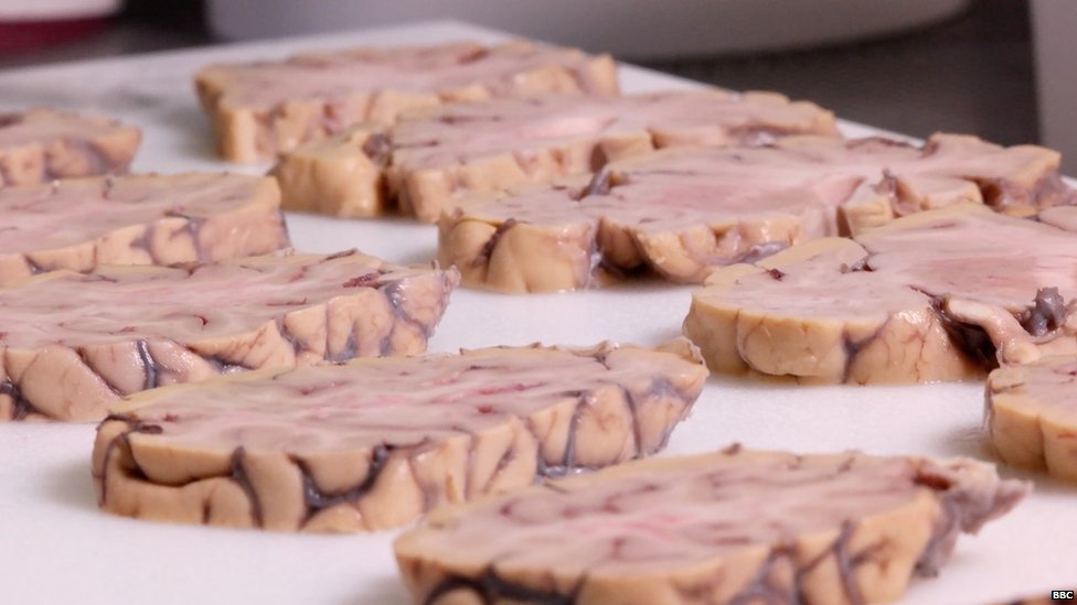 Slices of human brain