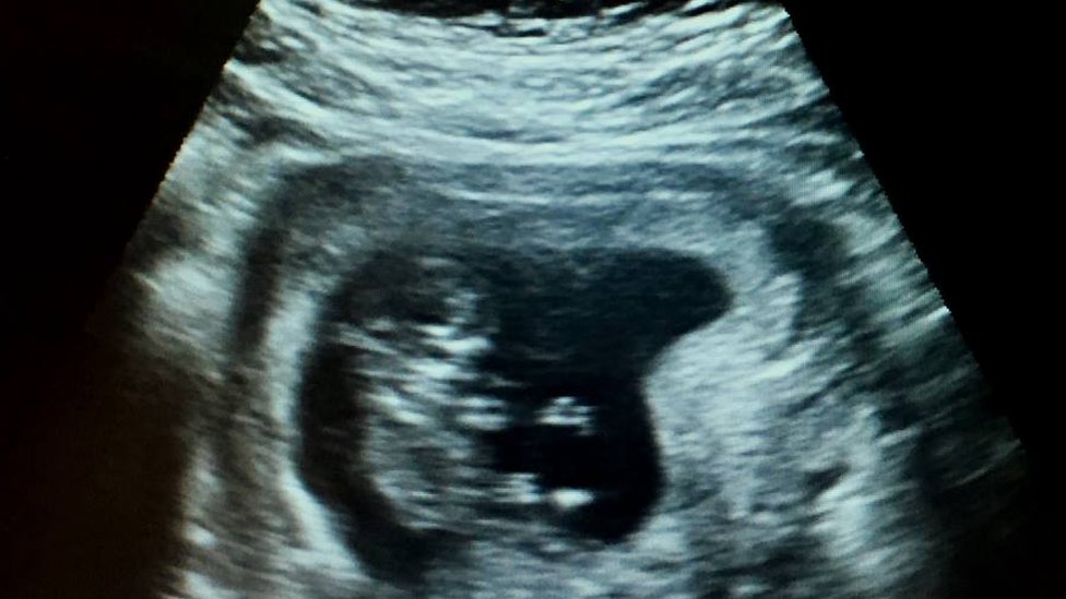 Scan of baby