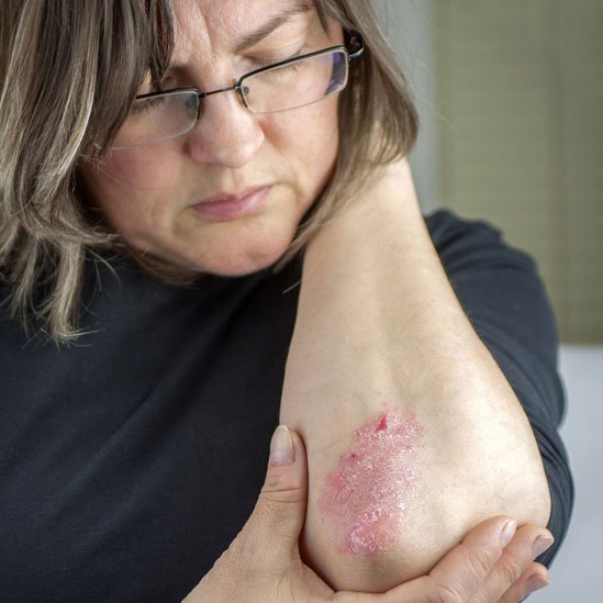 Mujer mostrando su codo con síntomas de psoriasis