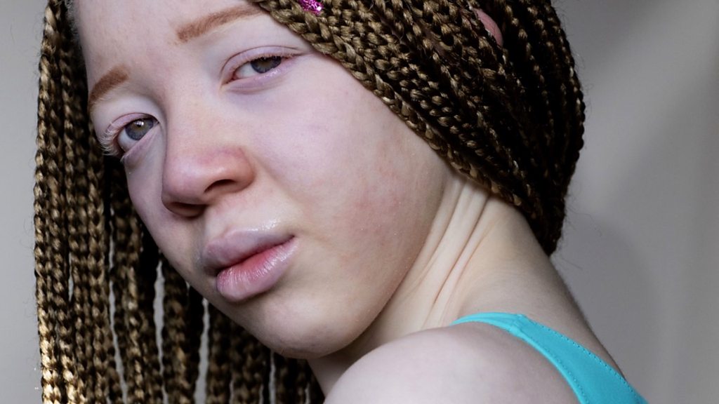 Teenage albino model: 'I'm thankful for my skin tone'