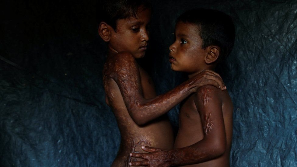 Kedua bersaudara Rohingya Mohamed Heron dan Mohamed Akter