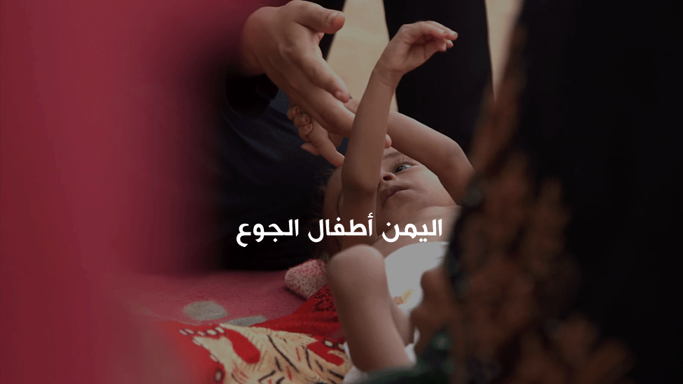 ليمن أطفال الجوع