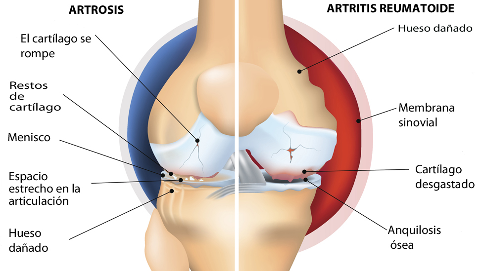 Imagen comparativa entre artrosis y artritis.
