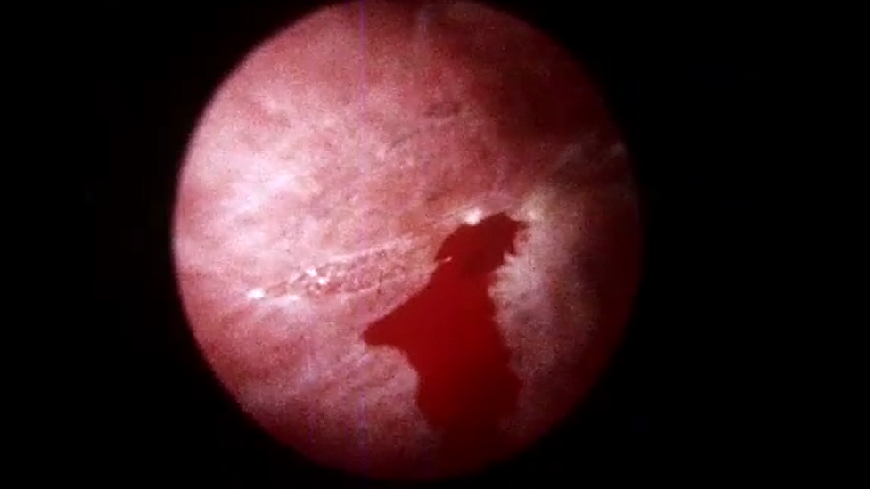 Tumor sangrando