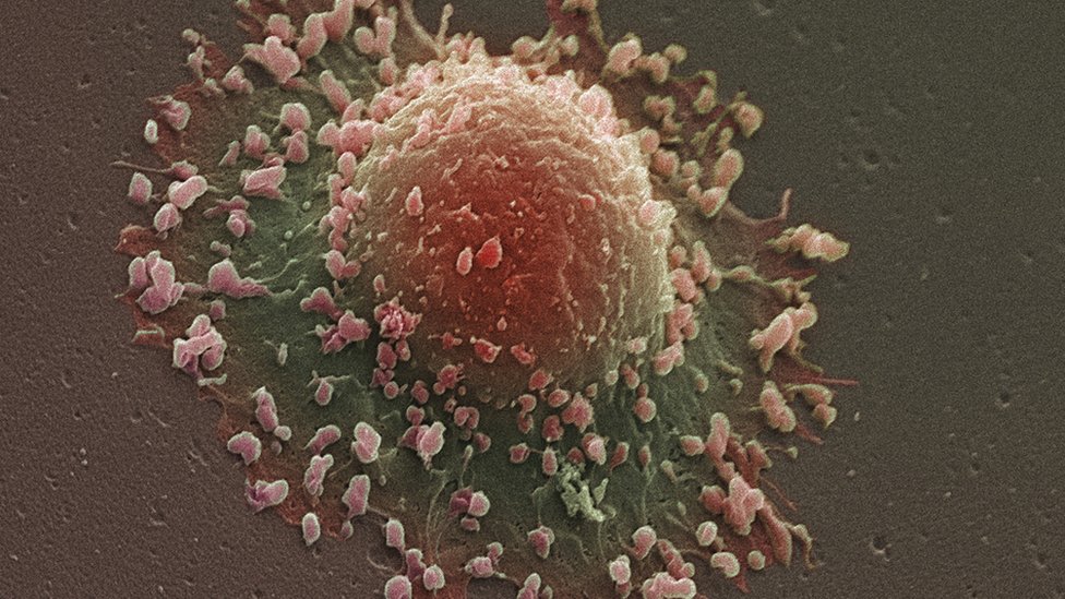 صورة مجهرية لخلايا سرطانية
