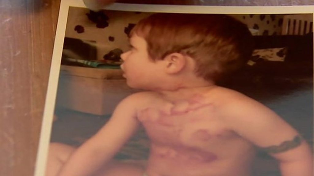 Firework injury 'changed our lives forever'