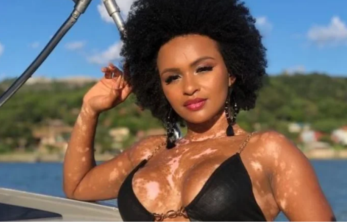 BBB22: pessoas com vitiligo dizem que presença de Natália ajudou a debater  preconceito - BBC News Brasil