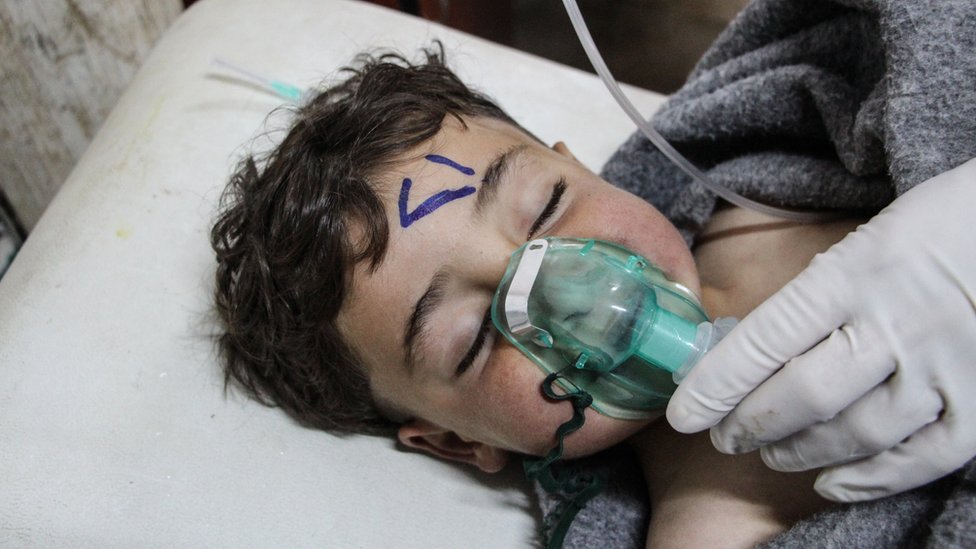 طفل سوري يعالج بعد الهجوم الكيماوي