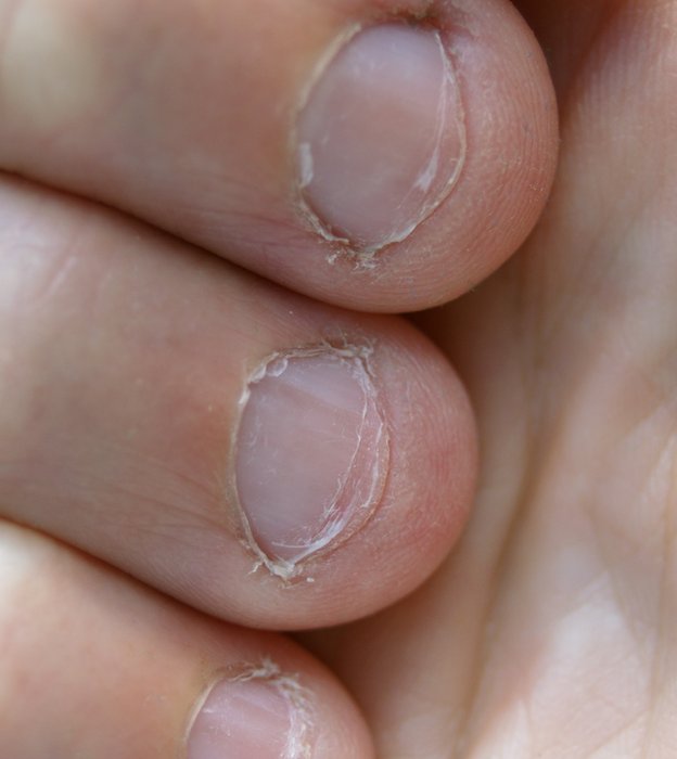 Dedos con uñas comidas