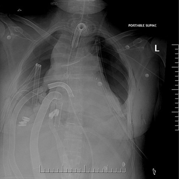 Tras la neumonectomía bilateral para tratar shock séptimo pulmonar.
