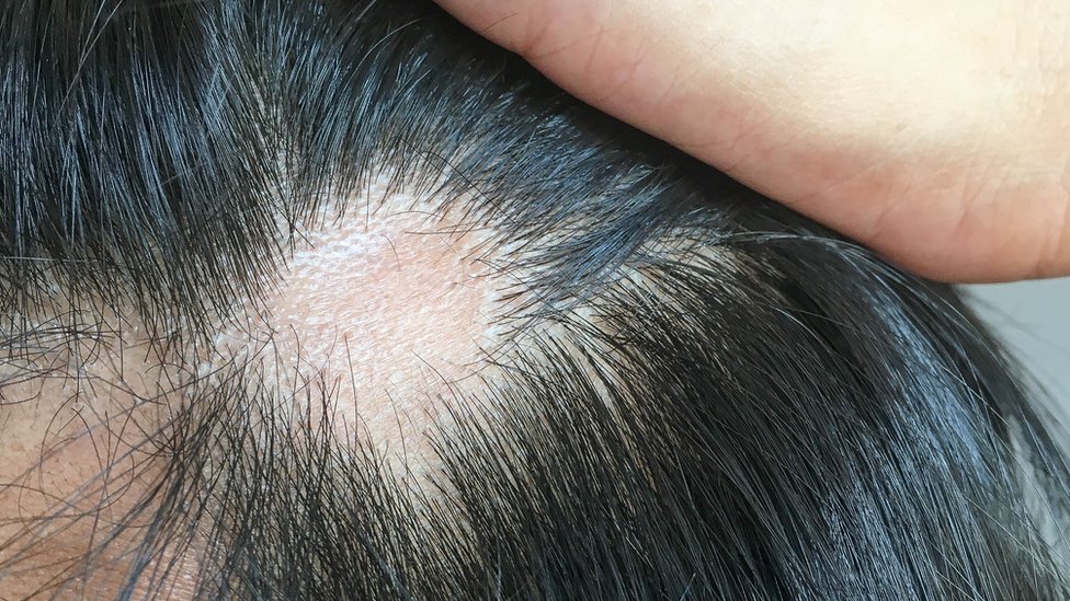 metálico Una buena amiga Dime Coronavirus: qué causa y cómo tratar la caída del cabello que afecta a uno  de cada cuatro infectados - BBC News Mundo
