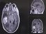 VIDEO: New scan aims to aid tumour detection