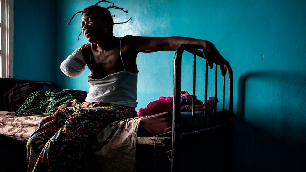 Una mujer de RDC con un brazo amputado tras ser herida con un disparo.