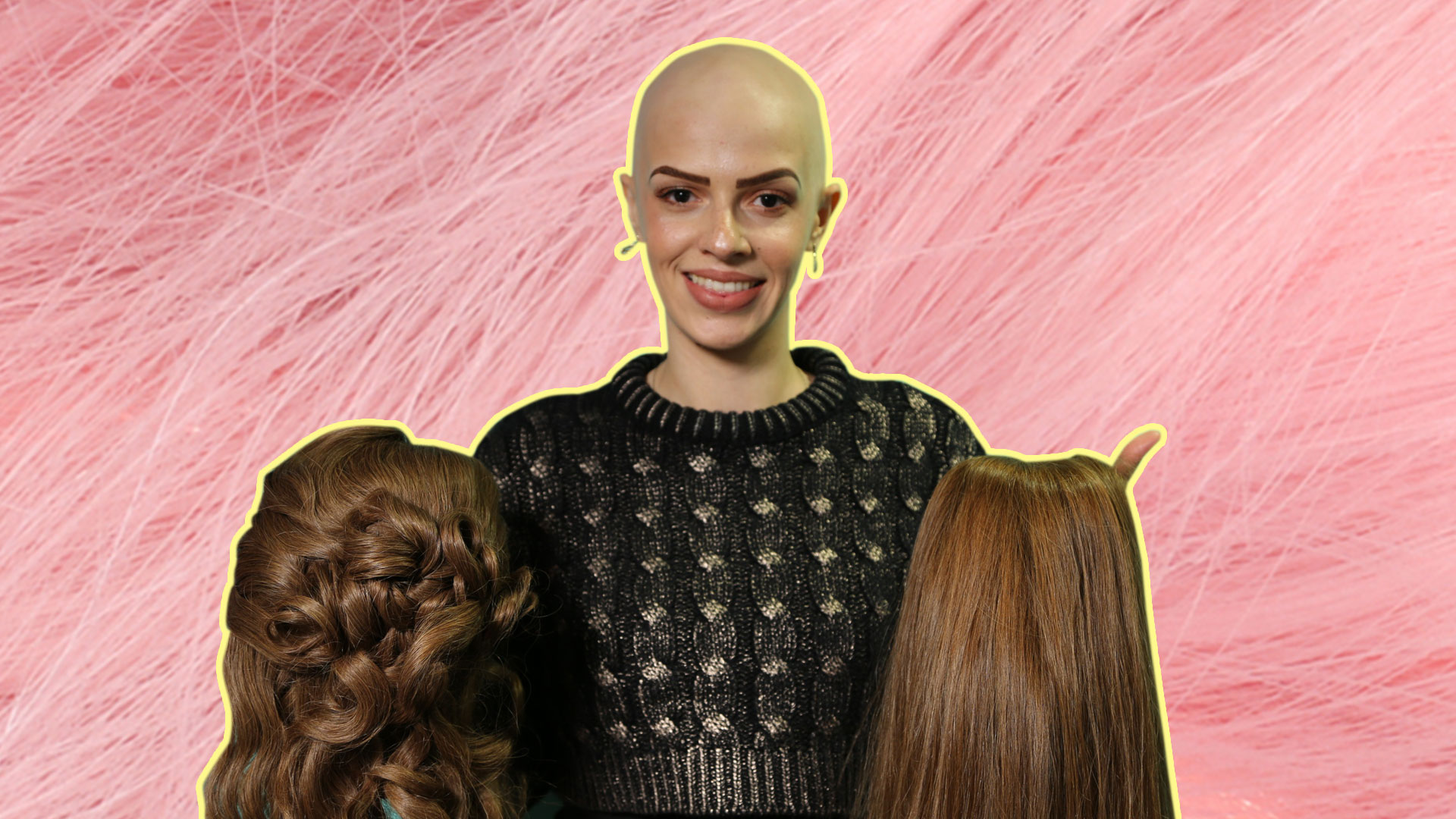Alopecia: I lost my hair aged one