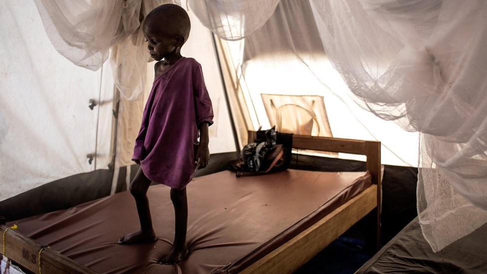 Un niño con desnutrición severa sobre su cama en un centro de rehabilitación en Tshikapa, RDC.