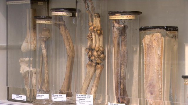 A Peek Inside Revamped Surgeons Hall Medical Museum BBC News