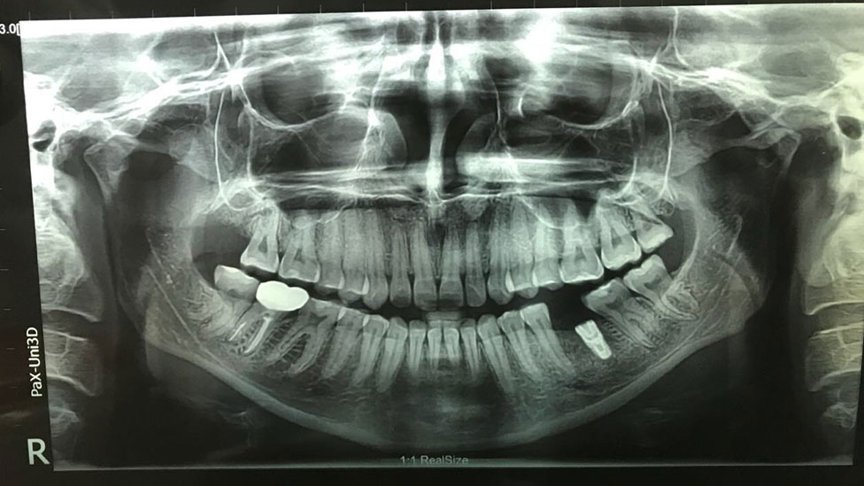 Radiografía de los dientes de Lizzie Porter