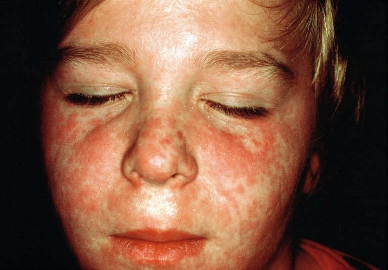 boy with measles