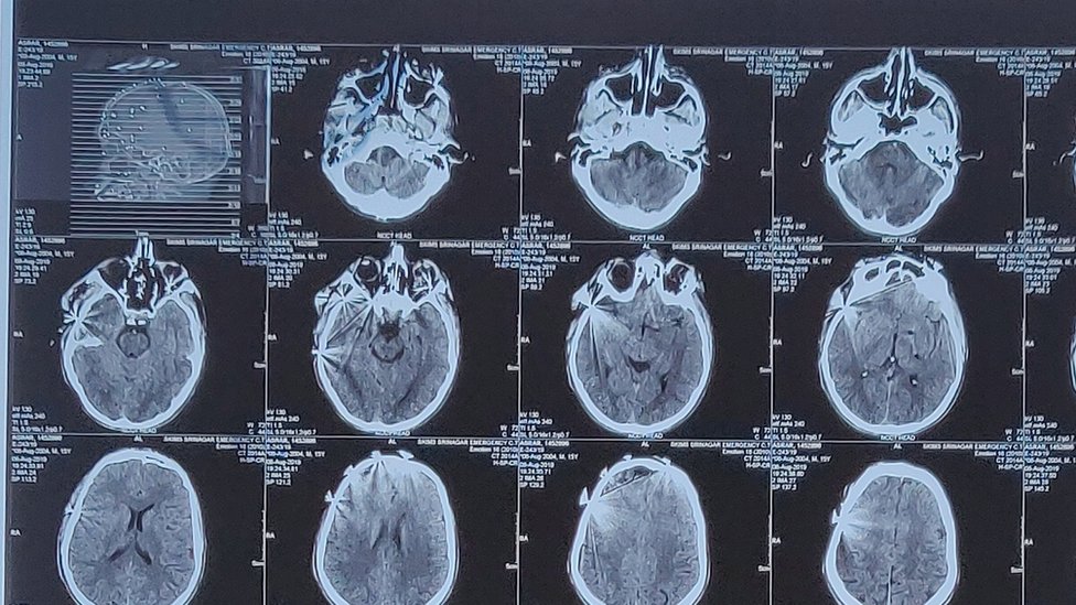 Фотография рентгеновского снимка черепа Асрара с гранулами, видимыми в верхнем левом углу сканирования