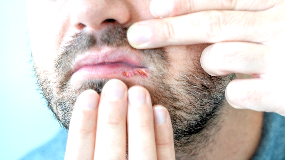 El herpes también puede causar llagas en la boca.