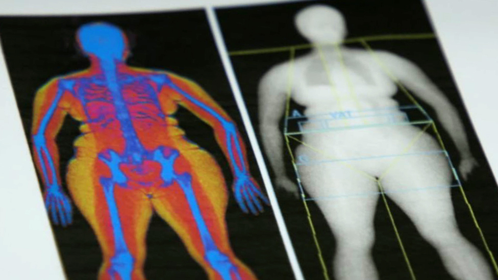 Escáner de grasa corporal que muestra la cantidad y y la distribución de grasa en el cuerpo.