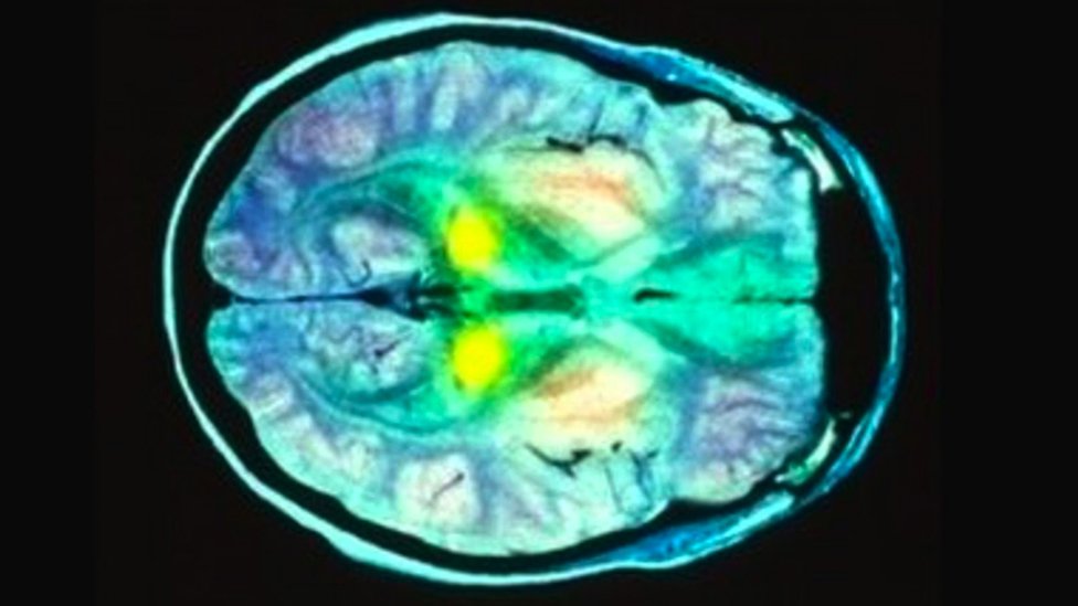 A brain scan showing part of the brain highlighted yellow