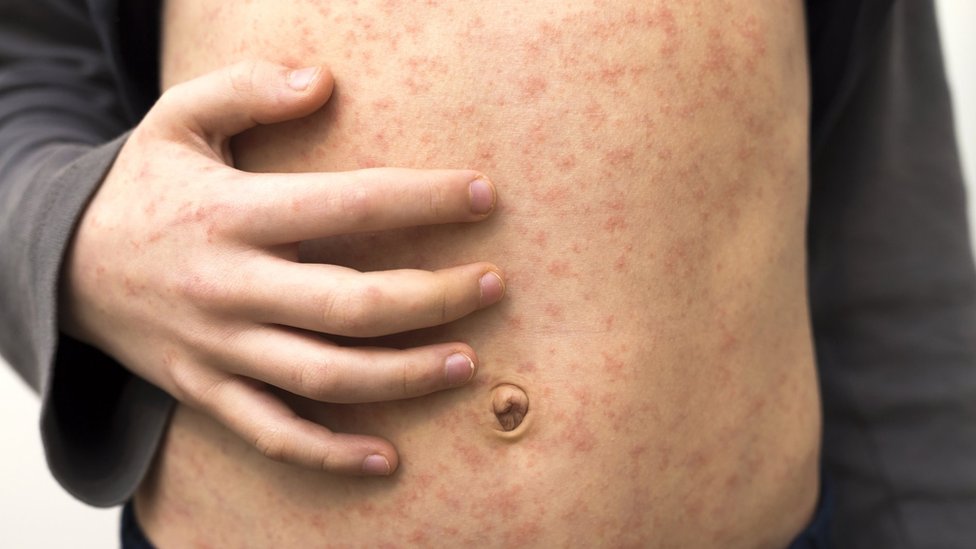 Measles Makes Body Forget How To Fight Infection Bbc News 5139