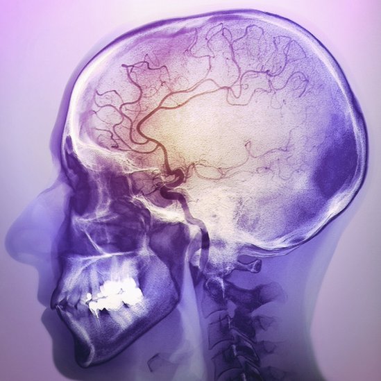 Cuando ocurre un infarto cerebral, cada minuto, mueren dos millones de neuronas. infarto cerebral