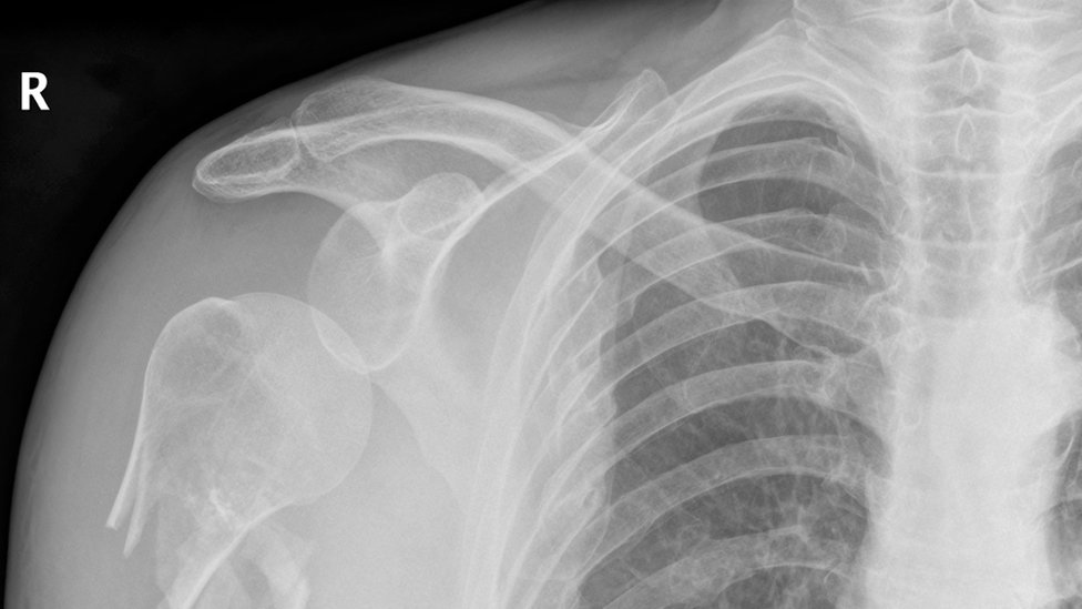 Una de las aplicaciones prácticas es el campo de la medicina: la luz podría utilizarse para detectar microfracturas. Radiografía