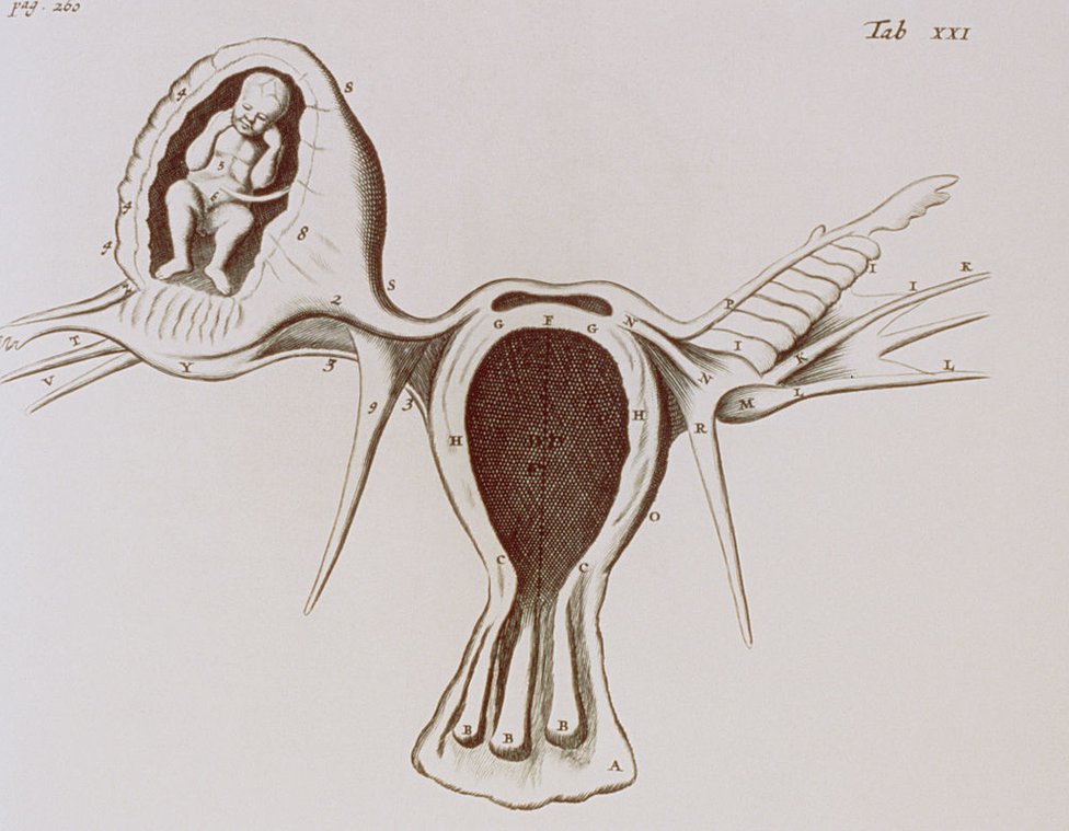 Gráfica de un embarazo ectópico de un libro de medicina