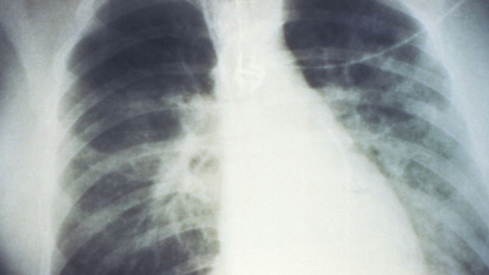 Radiografía pulmones hantavirus.