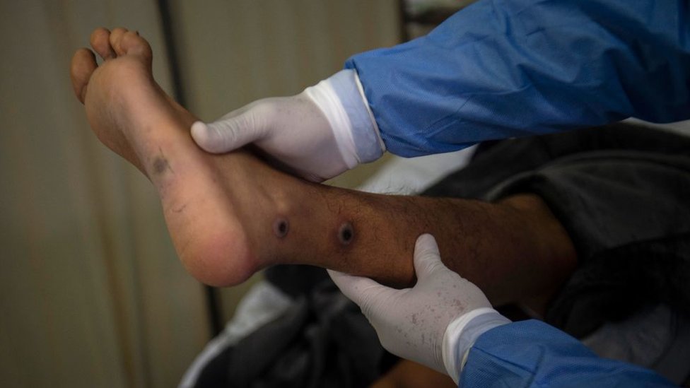 Un hombre en Perú contagiado por la viruela del mono