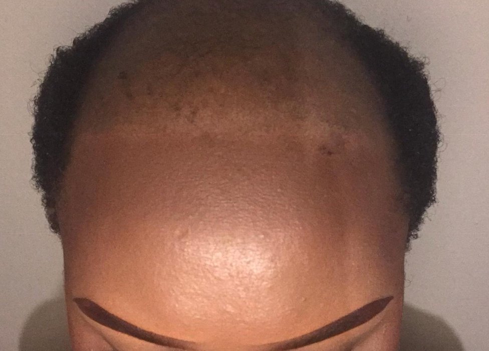 Drug reverses one baldness type; is male pattern next? - CNN