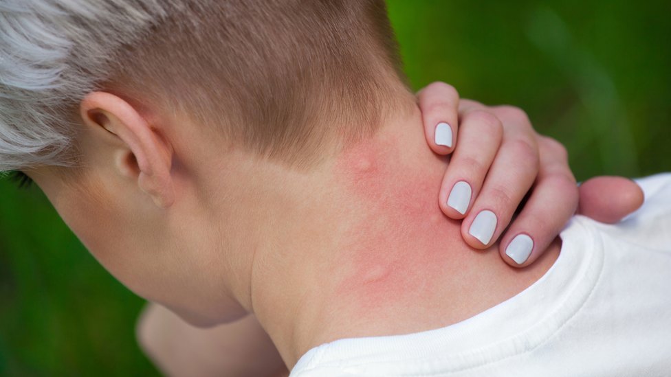 En Europa se registraron casos de "malaria de aeropuerto" en Francia, Bélgica, Italia, Holanda, España, Suiza y Reino Unido. Picaduras de mosquito