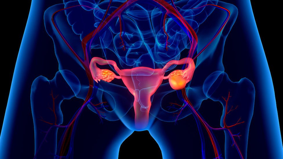 Cómo se forma, qué consecuencias tiene y cómo tratar el ovario  poliquístico? - BBC News Mundo