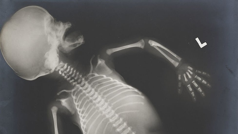 Radiografía fetal de un bebé.
