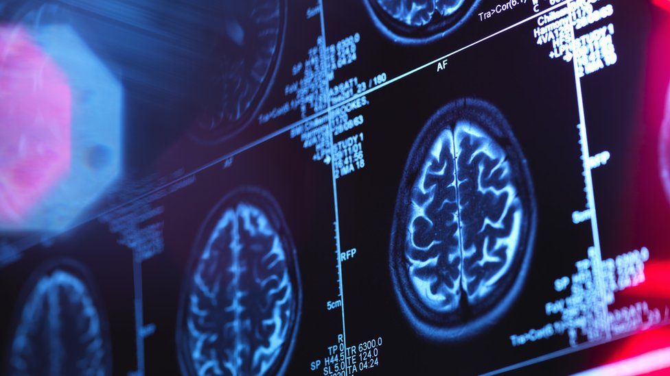 Новости науки: как разглядеть Альцгеймера на снимке МРТ, и кому нужен обет безбрачия?