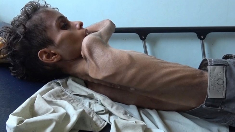 طفل يمني يعاني من سوء التغذية