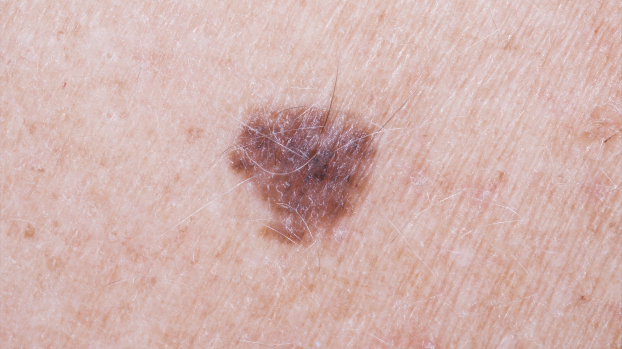 Arm mole count 'predicts skin cancer risk' - BBC News