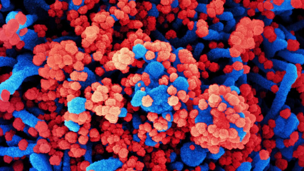 Células de paciente (em azul) infectadas com partículas do coronavírus (vermelho) em imagem do tipo micrografia eletrônica, divulgada pelo National Institutes of Health dos EUA
